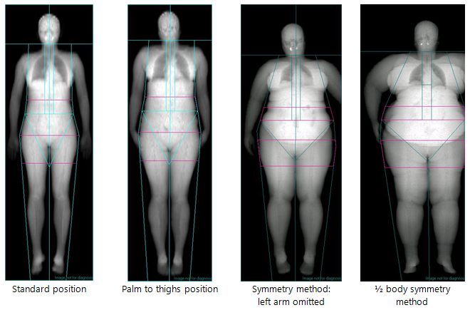 Dexa Scan for Osteoporosis in Fresno, CA- $150 Full Body Scan