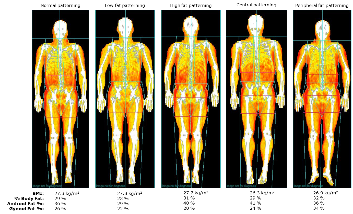 Whole Body Composition